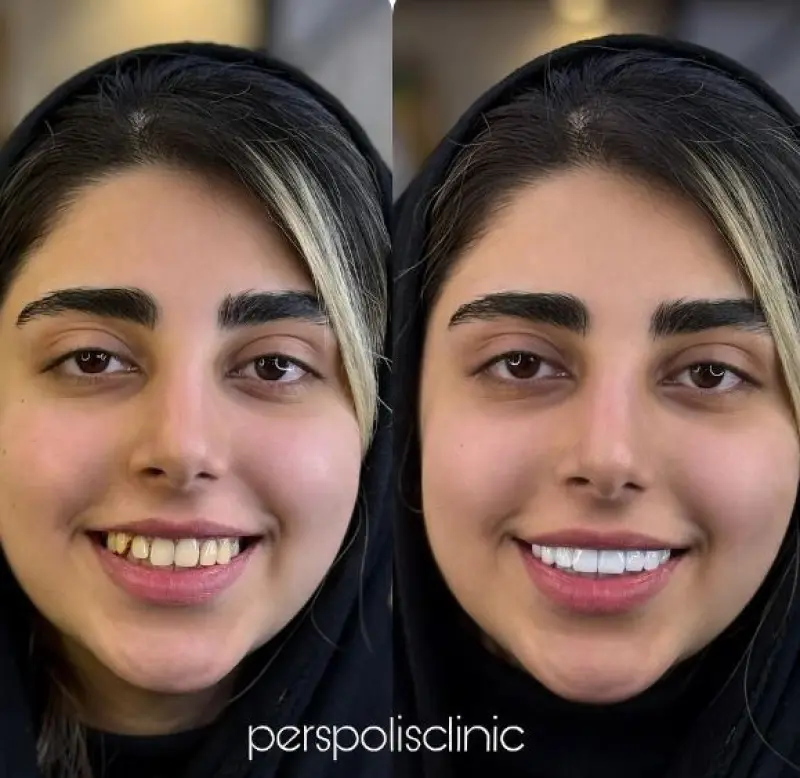 کامپوزیت دندان
