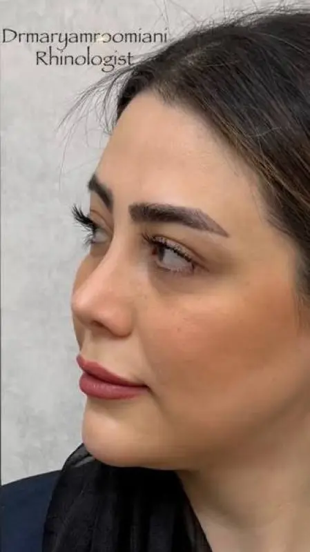 جراحی بینی 